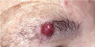 Detecting cancer in its early stages increases the likelihood that you'll be able to successfully treat it. 5 Uncommon Cutaneous And Subcutaneous Malignancies Identification Diagnosis And Treatment Consultant360
