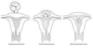 Summary as you can see, there are many risk factors, symptoms, and technologies that your specialist can use to help screen for any cancers, particular uterine sarcomas that may be mistaken for benign fibroids. Overview Of Latest Evidence On Uterine Fibroids Nursing For Women S Health