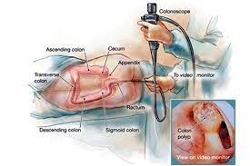 Classificazione classificazione e terapia endoscopica. Colonoscopie Sigmoidoscopie