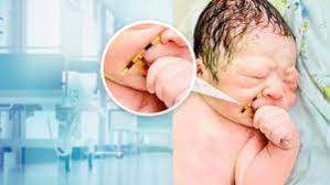 Trotz Verhutung Schwanger Spirale Kommt Bei Geburt Mit Dem Baby Raus