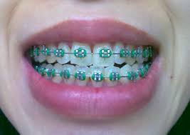 See more ideas about braces colors, braces, cute braces colors. Green Hair