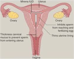 All iuds must be placed into your uterus and removed by a doctor. Intrauterine Device An Overview Sciencedirect Topics