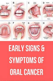 Early Signs Symptoms Of Oral Cancer Oral Cancer Gum Disease Cure Gum Disease