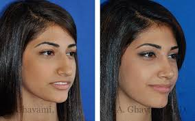 Before After Nose Surgery Pictures In Beverly Hills Los Angeles Dr Ghavami Nose Surgery Rhinoplasty Before And After Rhinoplasty Nose Jobs