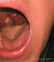 Image result for Strep throat infection roof of mouth