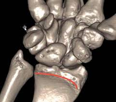 Maybe you would like to learn more about one of these? Https Www Handchirurgie Ravensburg De Fileadmin Benutzerdaten Handchirurgie Ravensburg De Pdf Publikationen Handchirurgie Scan Distale Radiusfraktur Pdf