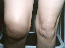 Tina Rappaport My Story About How Alkaline Ionized Water Changed My Life Swollen Knee Foot Remedies Swollen Feet Remedy