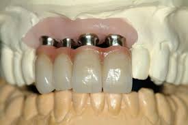 Manage the opening for the abutment screw. Implant Cementation Step By Step Nobel Biocare Blog