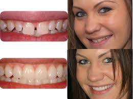 Veneers Behandlungsmethoden Und Kosten Beautymay