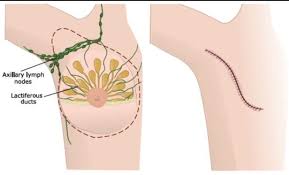 Breast cancer can recur at the original site (called local recurrence). Current Strategies For The Management Of Locoregional Breast Cancer Recurrence