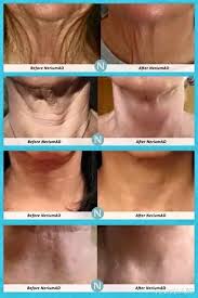 Turkey Neck Nerium Can Help Arubrecht Arealbreakthrough Com Anti Aging Skin Products Healthy Skin Cream Anti Aging Skin Treatment