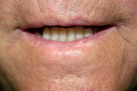 Image result for Lip Cancer