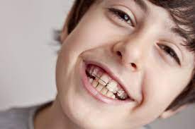 So if you do want colored braces they may cost more. Diy Braces When Not To Do It Yourself