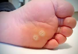 Identifying a dead or dying wart can prove to be difficult for people who don't know what it looks like. Plantar Wart Treatment Plantar Wart Doctor In Plano