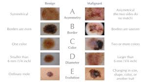 Did you know that mole hairs tend to grow longer than other hairs in the area? Know Your Abcdes Aim At Melanoma Foundation