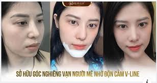 Cằm ngắn, cằm lẹm, cằm thiếu độ nhô khiến khuôn mặt bạn mất cân đối, không