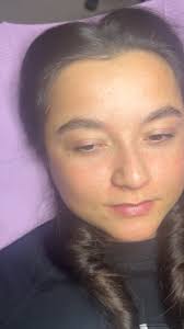 ✨ Skin Transformation Journey ✨ A powerful combination of HIFU, Ultrasound  Therapy, Lifted Therapy, and Microneedle Radiofrequency has brought these  amazing results. We started this process back in May, and now, at