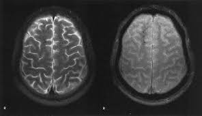 Image result for Diffuse Axonal Injury
