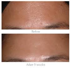 The creators of the original glycolic acid peel with regular use, the exuviance performance peel ap25 is an ideal way to significantly reduce visible. Exuviance Performance Peel Ap25 Review A Helicopter Mom