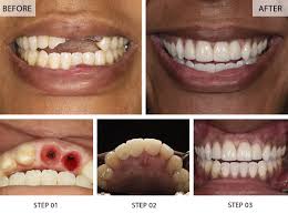 Image result for dental implant