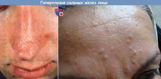 Атеромы считаются доброкачественными образованиями, появляющимися на любом участке тела, где присутствуют сальные железы. Lechenie Giperplazii Salnyh Zhelez Na Lice Narodnymi Sredstvami