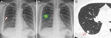 Image result for lung cancer xray