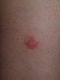 Tuttavia, questi cambiamenti della pelle, soprattutto sul collo, sono molto visibili, possono impigliarsi in vestiti o gioielli e provocare irritazione, quindi è naturale volersene sbarazzare. Porro Della Pelle Come Eliminarlo