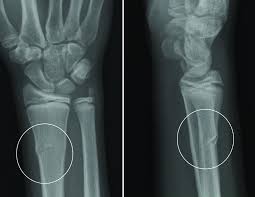 Maybe you would like to learn more about one of these? Buckle Fracture Raleigh Hand Surgery Joseph J Schreiber Md