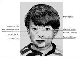 Fetal alcohol syndrome epicanthal folds flat nasal bridge small palpebral fissures upturned nose. Characteristic Facial Features In Fetal Alcohol Spectrum Disorders Download Scientific Diagram