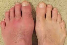 While regularly if the patient. Gout Online Healing By Homeopathy Dare To Know