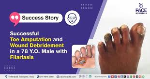 Image result for toe amputation