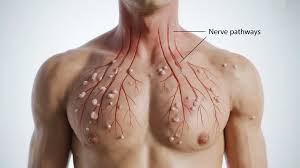 Image result for zoster under breasts