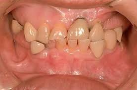 Image result for Tooth Attrition
