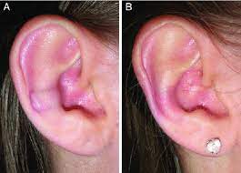 A 15 Year Old Female Patient 64 With Hypertrophic Scarring A Download Scientific Diagram