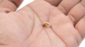 Image result for Tonsillolith