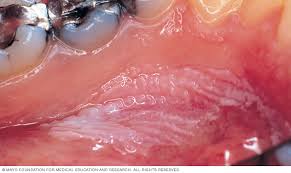 Image result for gums cancer symptoms