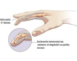 Exercitii pentru degete amortite cu mingea. ArticulaÈ›iile Degetelor Inelare De Pe Ambele Maini Doare Durere In ArticulaÈ›ia Degetului Inelar DimineaÈ›a Degetul De Declansare Paralela45luxury Ro
