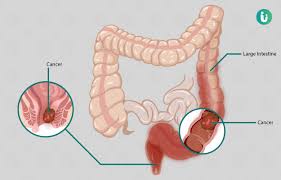 What are the types of colon cancer? Colorectal Cancer Symptoms Causes Treatment Medicine Prevention Diagnosis