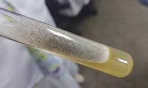 A zigomicose (mucormicose) é uma infecção rara, mas altamente invasiva, causada por fungos da ordem mucorales (gêneros rhizopus, mucor, rhizomucor, absidia, apophysomyces, saksenaea. Oncxchsr58eqnm