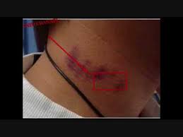 Jerawat di leher adalah benjolan kecil dan keras yang muncul di permukaan atau bawah kulit. Cara Efektif Menyembuhkan Bekas Luka Cupang Di Leher Hickeys Youtube