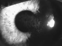 What Is This I Hear About Corneal Haze After Prk? | Barrett Eubanks, M.D.