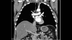 Computertomographie Des Thoraxbereiches Lunge Ct Mrt Institut Berlin