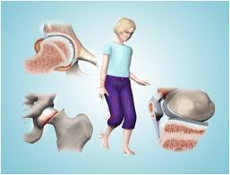Image result for Pediatric Limp
