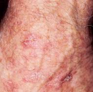 This can remove lesions from the face and scalp, and actinic cheilitis from the lips. Actinic Keratosis Warning Signs And Images The Skin Cancer Foundation