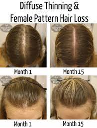 It Is Time To Quit Being Disturbed Over Your Loss Of Hair And Time To Start Taking Activity Take The Hair Loss Remedies Women Hair Loss Remedies Thining Hair
