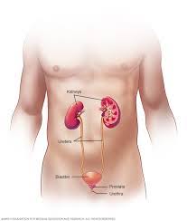 Infection may spread from the bladder to one or both kidneys. Bladder Cancer Symptoms And Causes Mayo Clinic