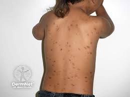 Image result for Urticaria pigmentosa children
