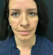 Rhinoplasty Before & After Photos