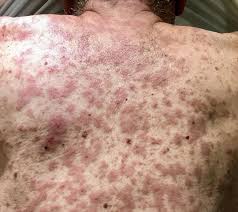 Image result for skin rash acute hiv infection