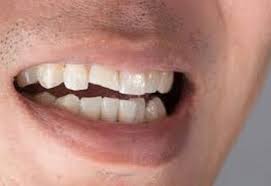 They can also use a toothbrush and floss to help remove a loose tooth without pain. Broken Teeth Treatment In Dublin Portobello Dental Clinic